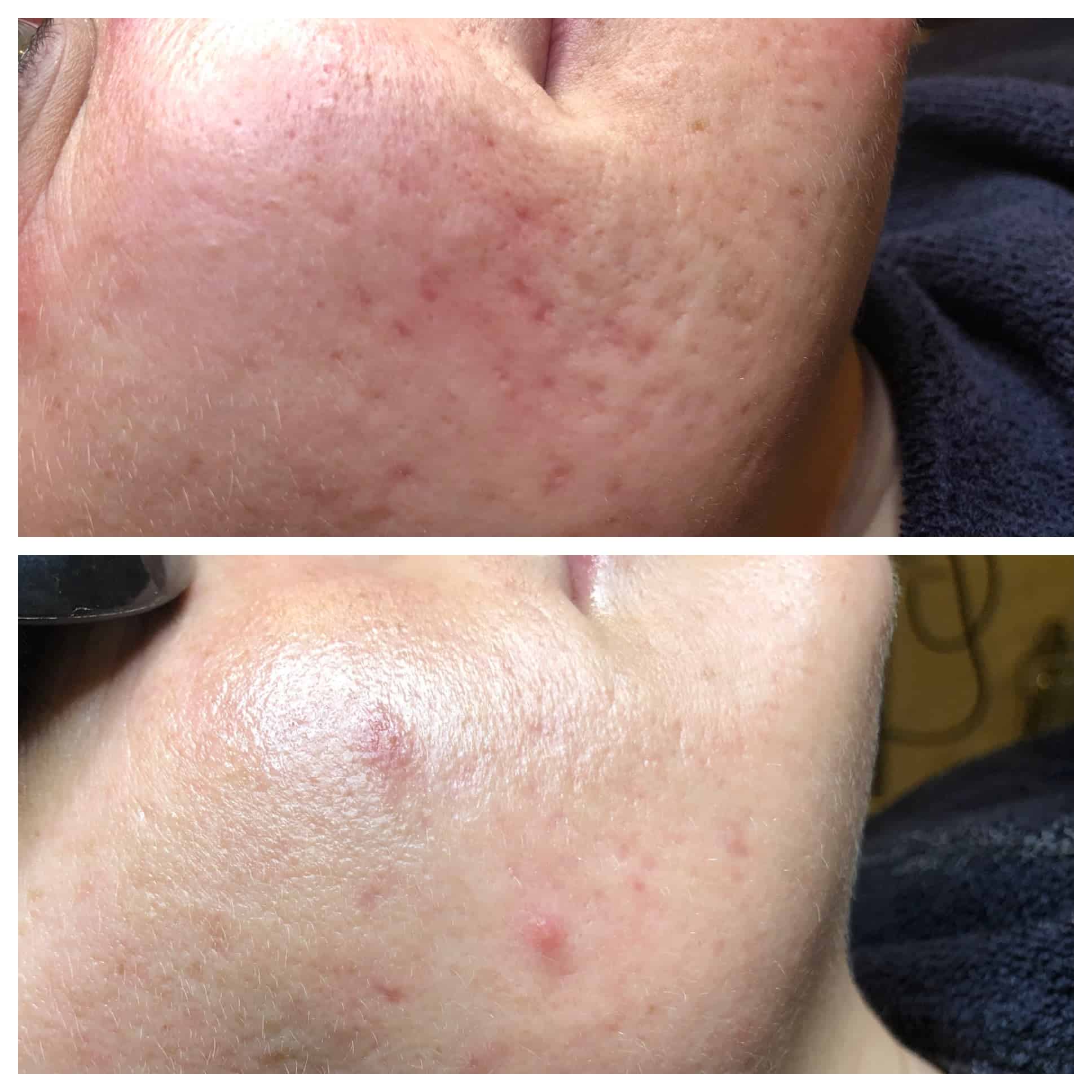 Fraxel Before and After Photo by Wyndhurst Aesthetics in Lynchburg, VA Fraxel Before and After Photo by Wyndhurst Aesthetics in Lynchburg, VA