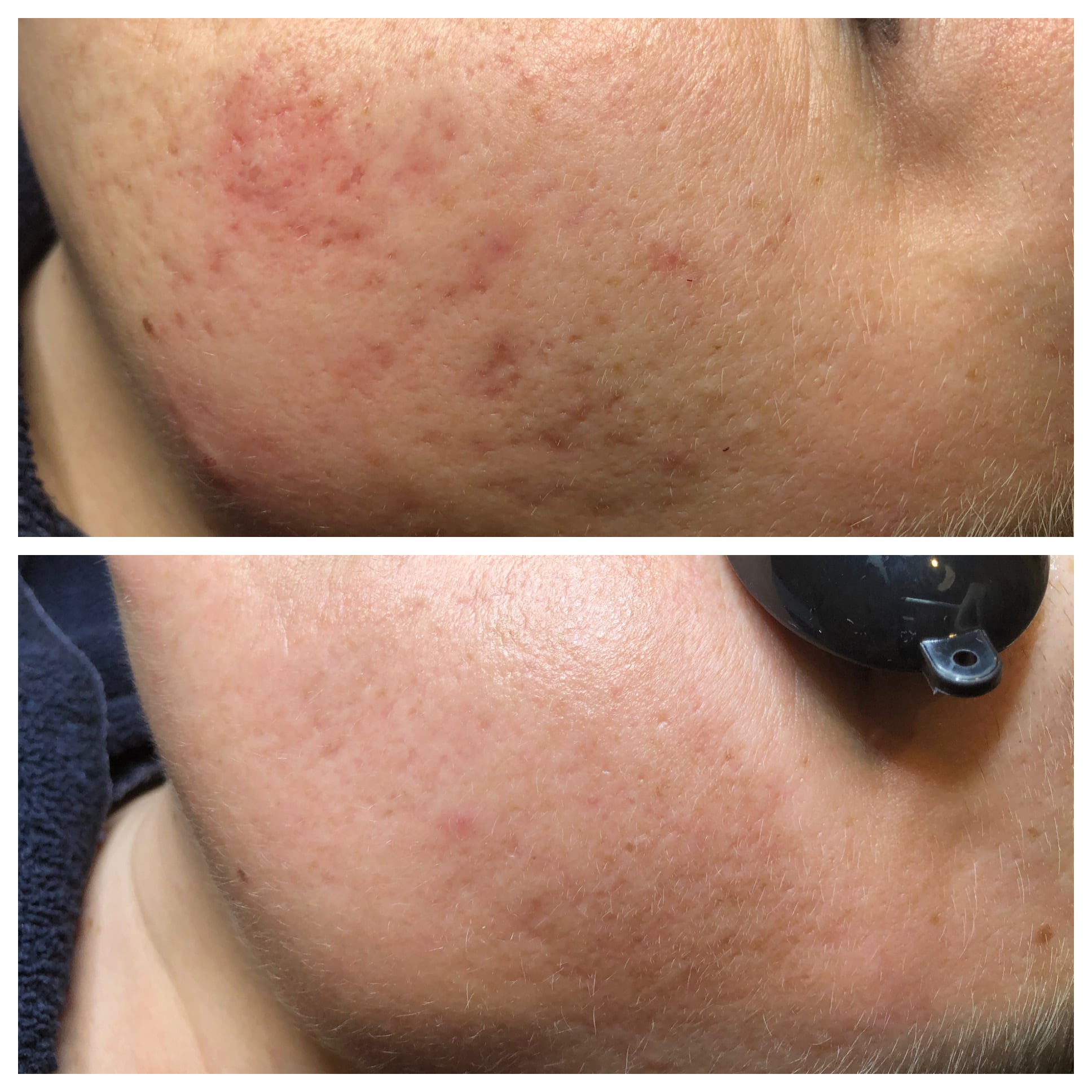 Fraxel Before and After Photo by Wyndhurst Aesthetics in Lynchburg, VA