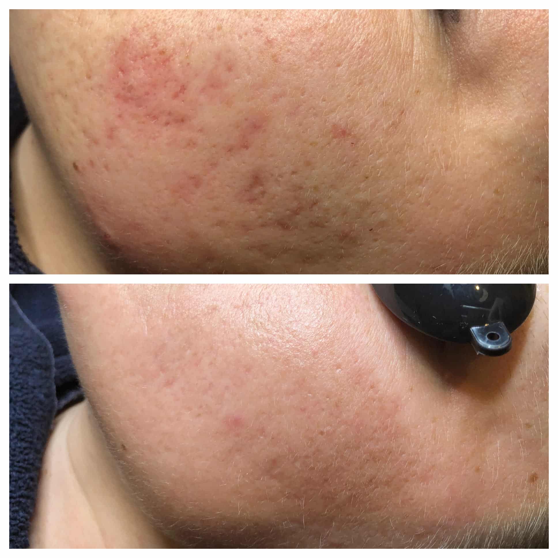 Fraxel Before and After Photo by Wyndhurst Aesthetics in Lynchburg, VA Fraxel Before and After Photo by Wyndhurst Aesthetics in Lynchburg, VA