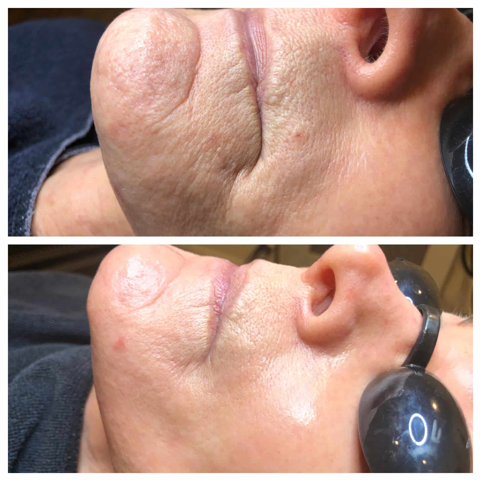 Fraxel Before and After Photo by Wyndhurst Aesthetics in Lynchburg, VA Fraxel Before and After Photo by Wyndhurst Aesthetics in Lynchburg, VA