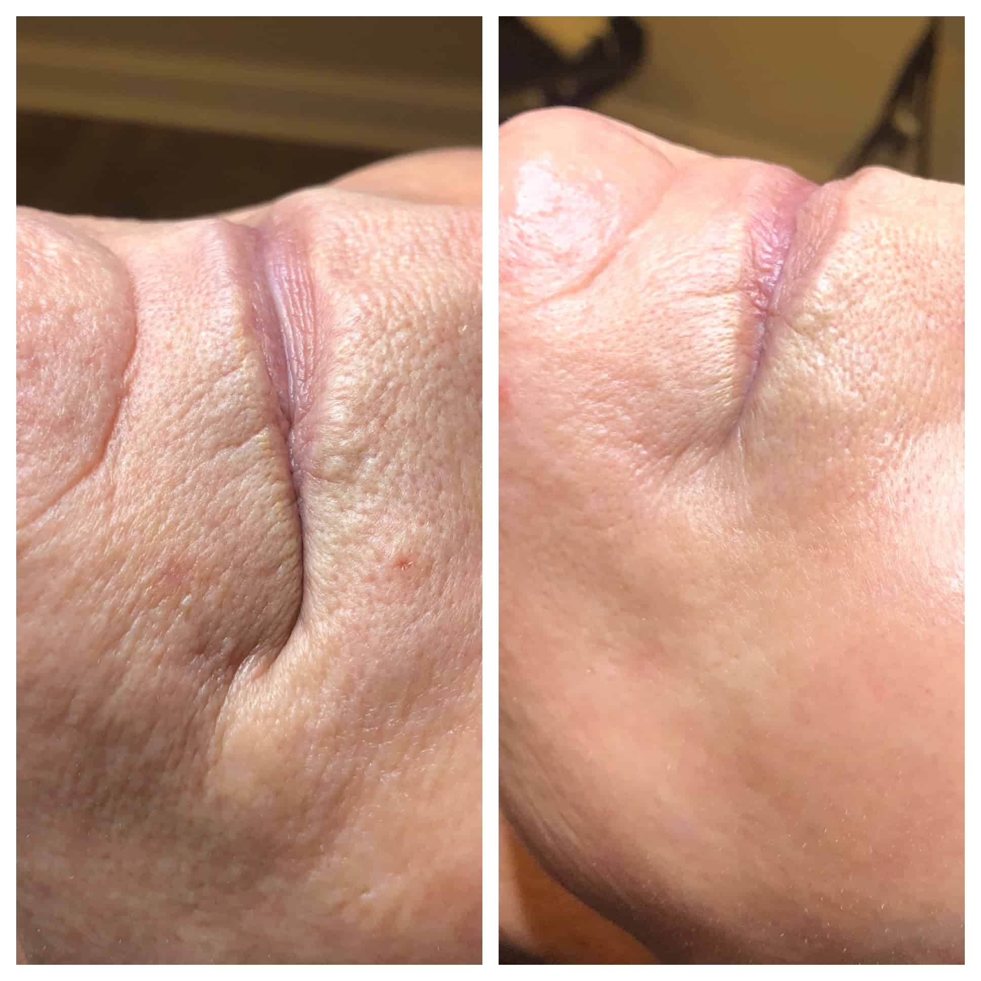 Fraxel Before and After Photo by Wyndhurst Aesthetics in Lynchburg, VA Fraxel Before and After Photo by Wyndhurst Aesthetics in Lynchburg, VA