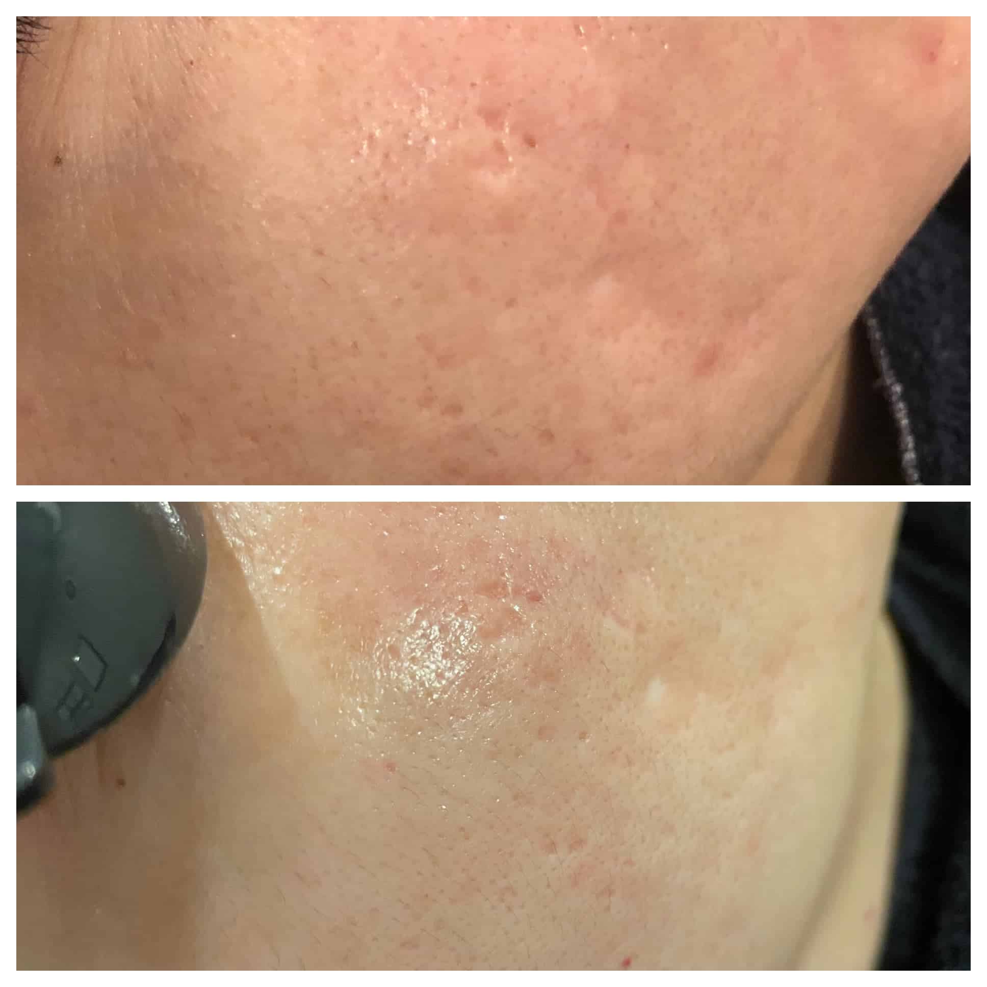 Fraxel Before and After Photo by Wyndhurst Aesthetics in Lynchburg, VA Fraxel Before and After Photo by Wyndhurst Aesthetics in Lynchburg, VA