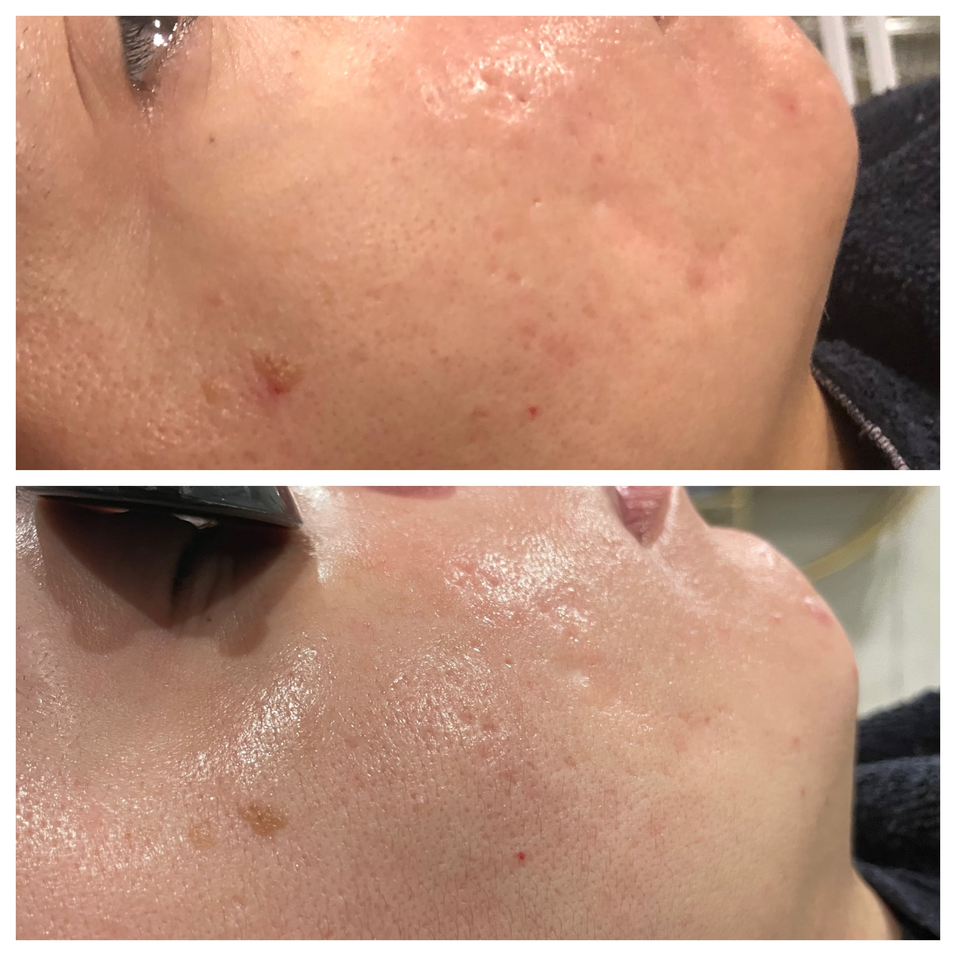 Fraxel Before and After Photo by Wyndhurst Aesthetics in Lynchburg, VA