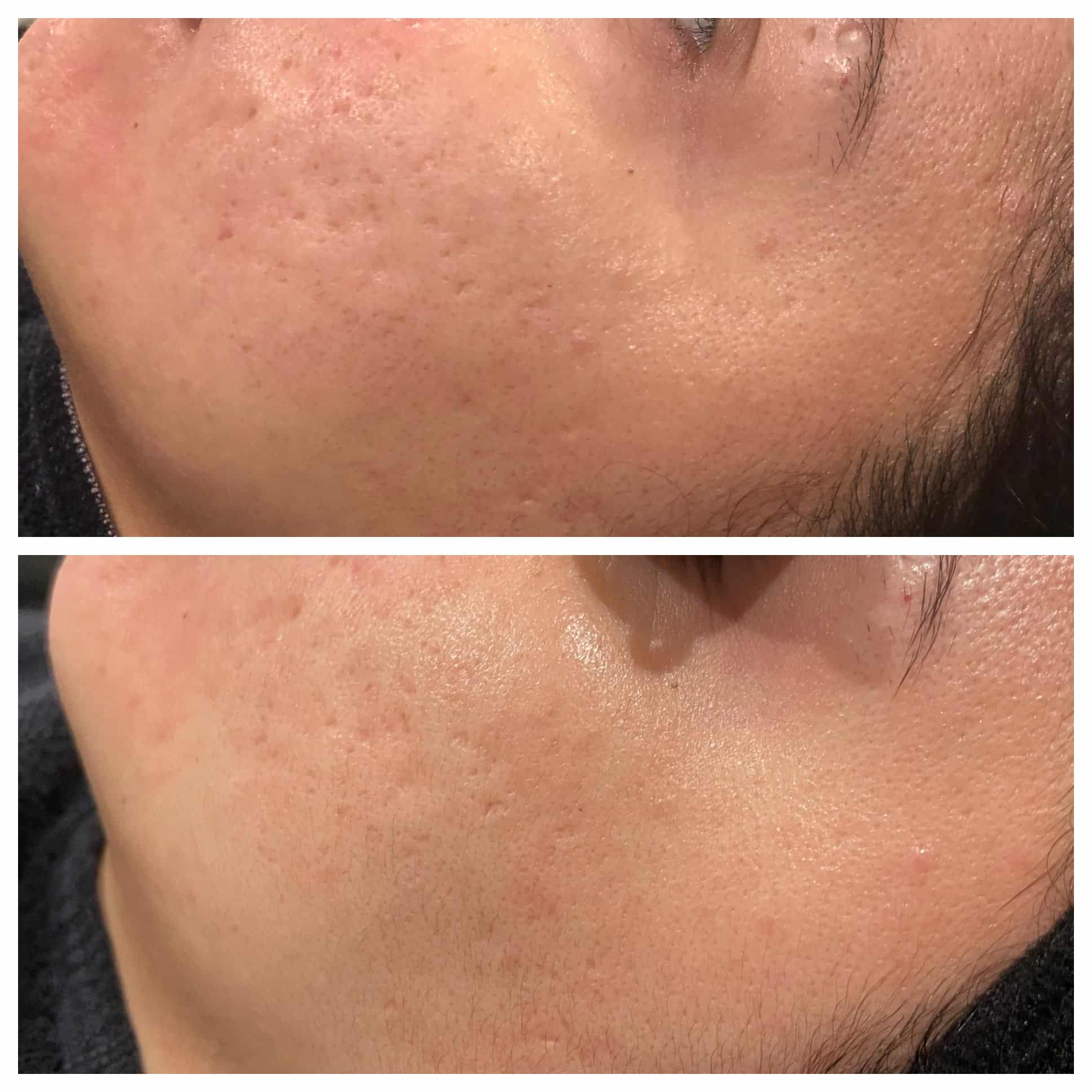 Fraxel Before and After Photo by Wyndhurst Aesthetics in Lynchburg, VA Fraxel Before and After Photo by Wyndhurst Aesthetics in Lynchburg, VA