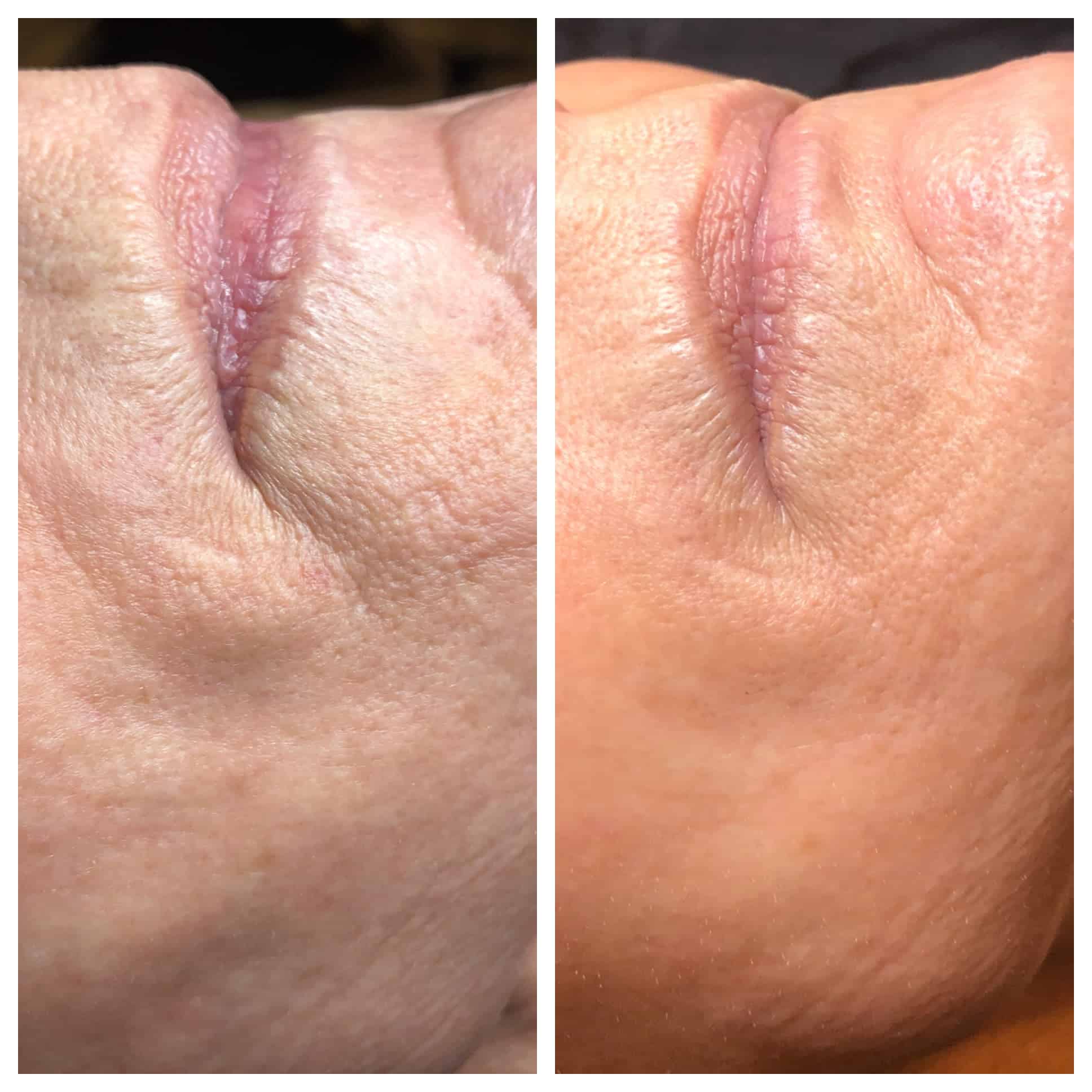 Fraxel Before and After Photo by Wyndhurst Aesthetics in Lynchburg, VA Fraxel Before and After Photo by Wyndhurst Aesthetics in Lynchburg, VA