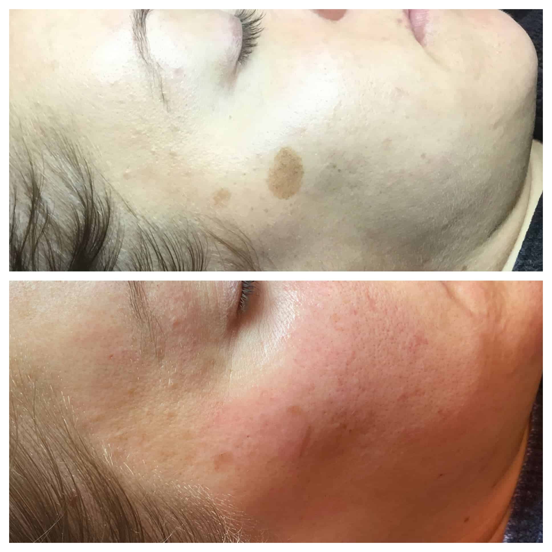 Laser Facial Before and After Photo by Wyndhurst Aesthetics in Lynchburg, VA Laser Facial Before and After Photo by Wyndhurst Aesthetics in Lynchburg, VA