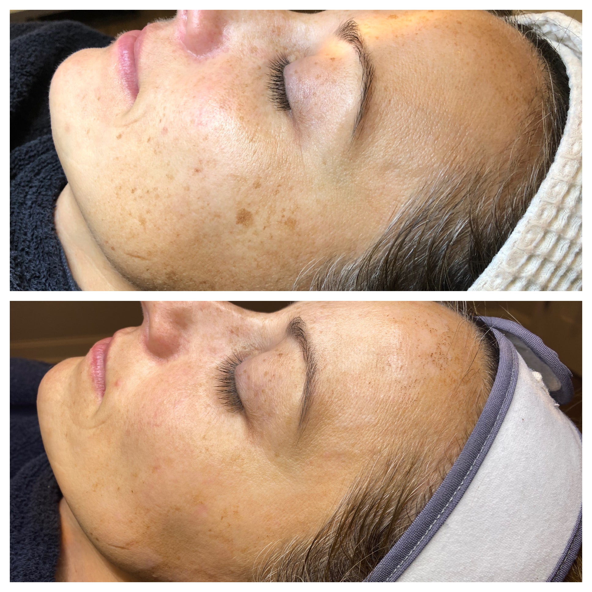 Laser Facial Before and After Photo by Wyndhurst Aesthetics in Lynchburg, VA