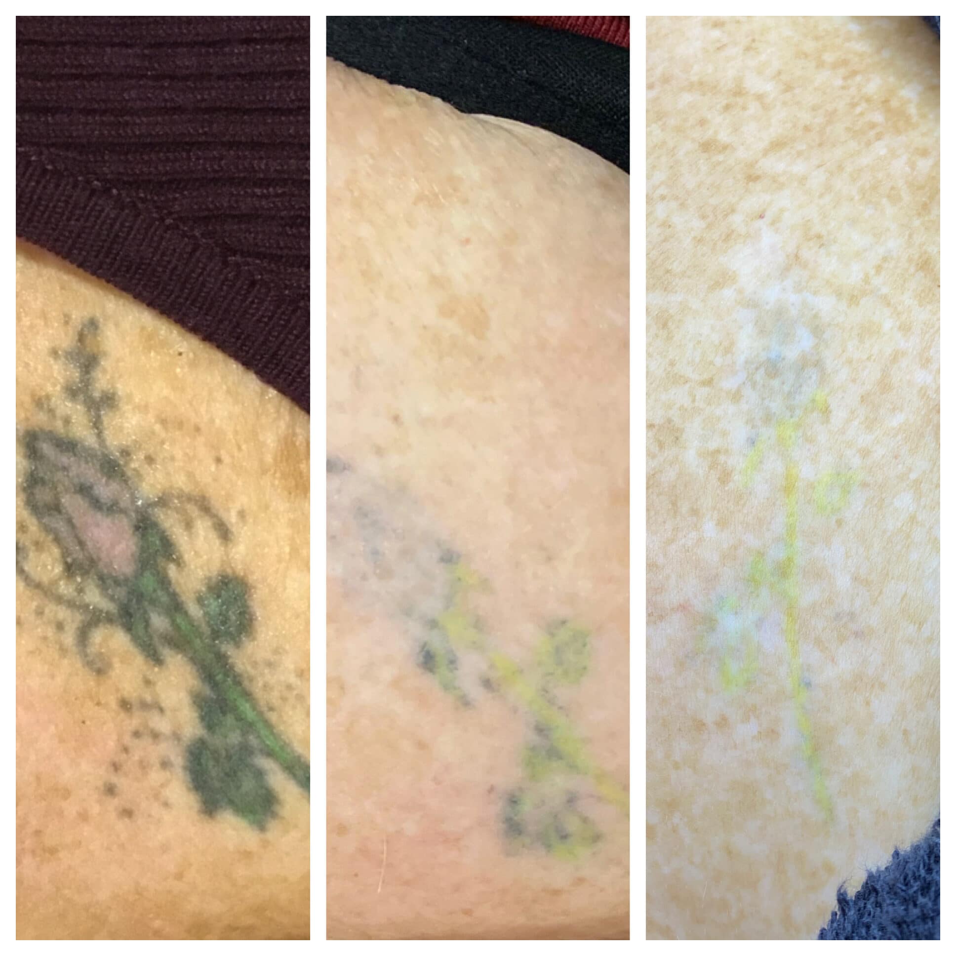 Laser Tattoo Removal Before and After Photo by Wyndhurst Aesthetics in Lynchburg, VA
