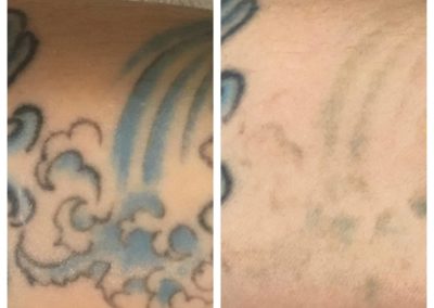 picosure laser tattoo removal near me