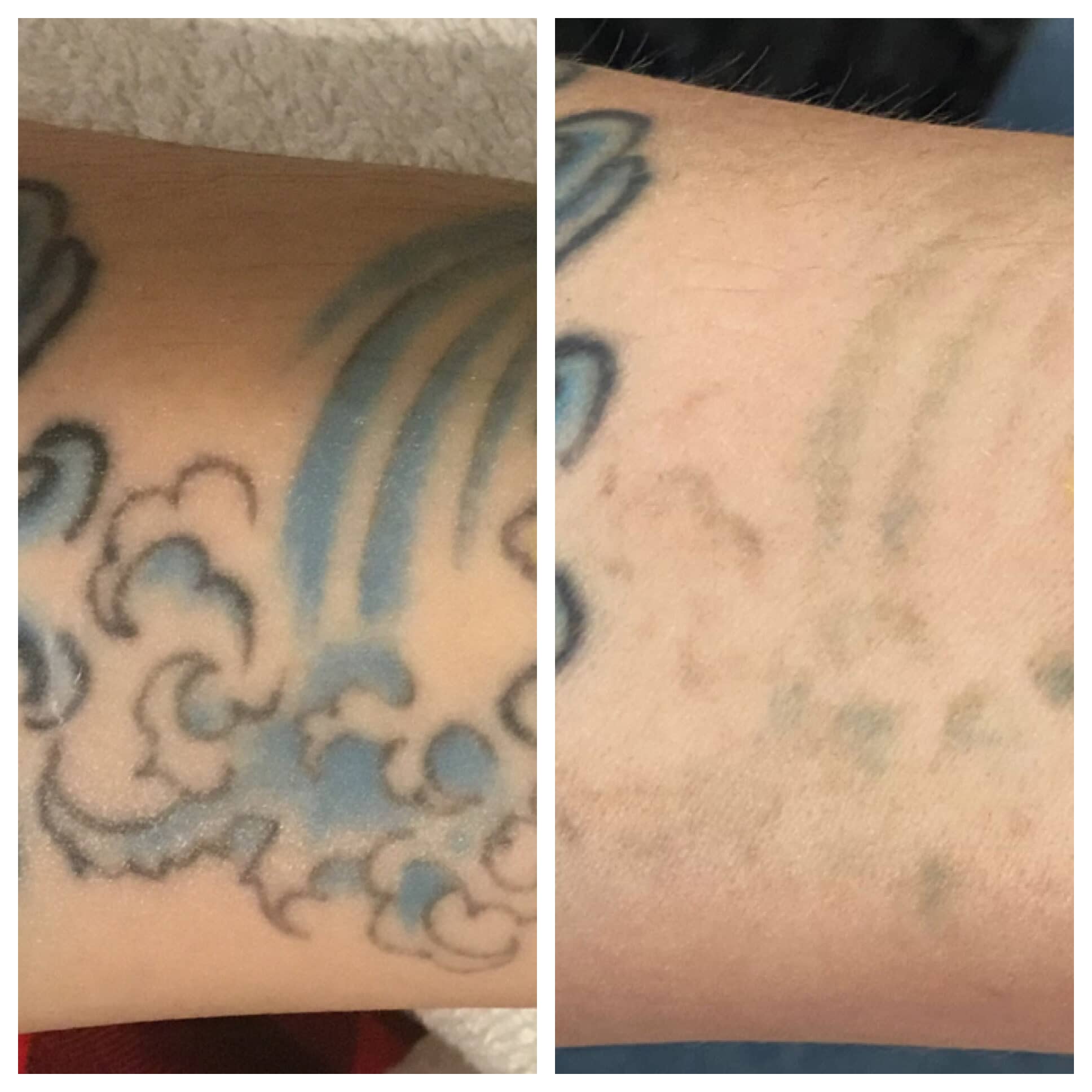 Laser Tattoo Removal Before and After Photo by Wyndhurst Aesthetics in Lynchburg, VA Laser Tattoo Removal Before and After Photo by Wyndhurst Aesthetics in Lynchburg, VA
