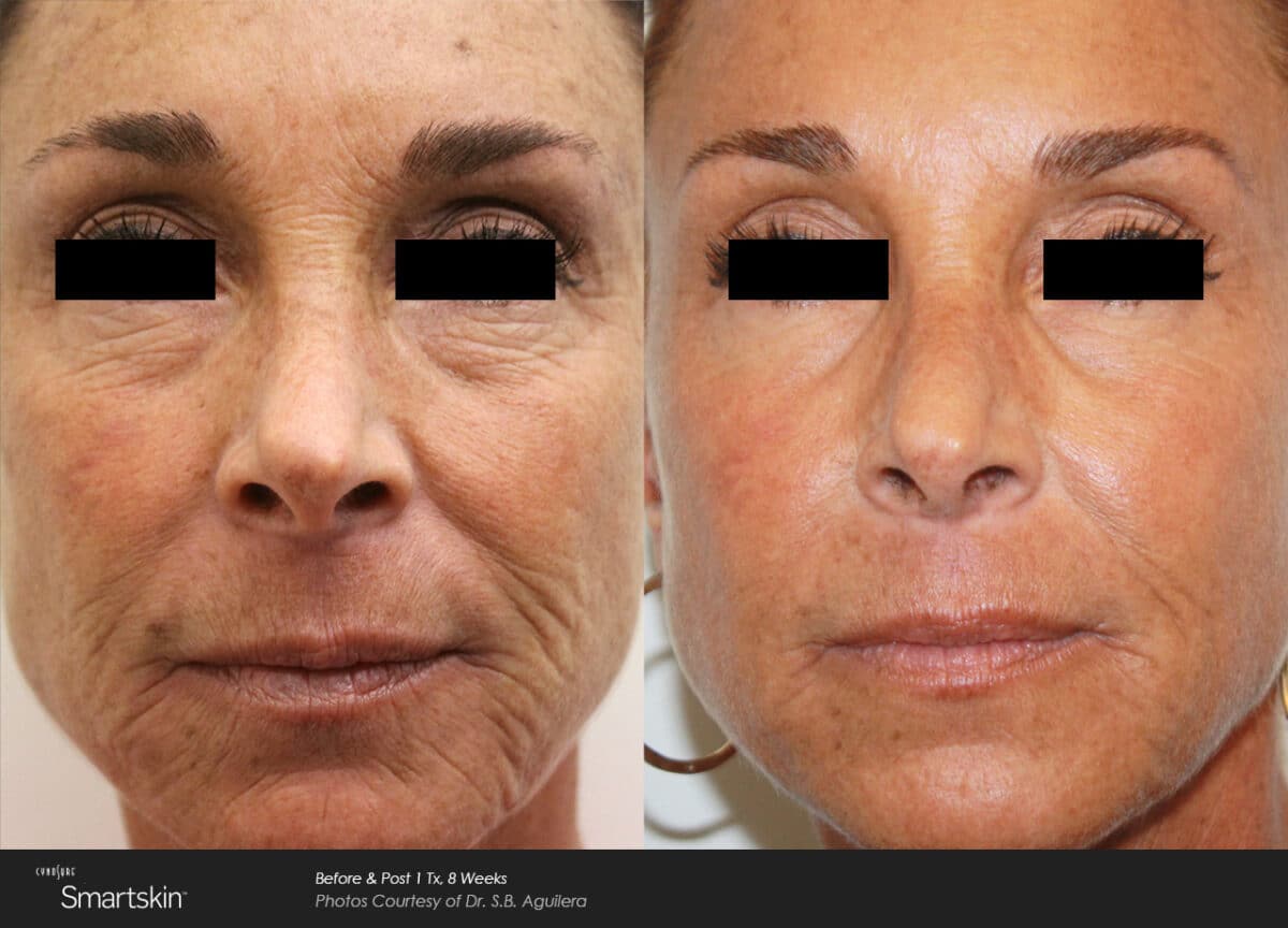 Laser Skin Resurfacing Before and After Photo