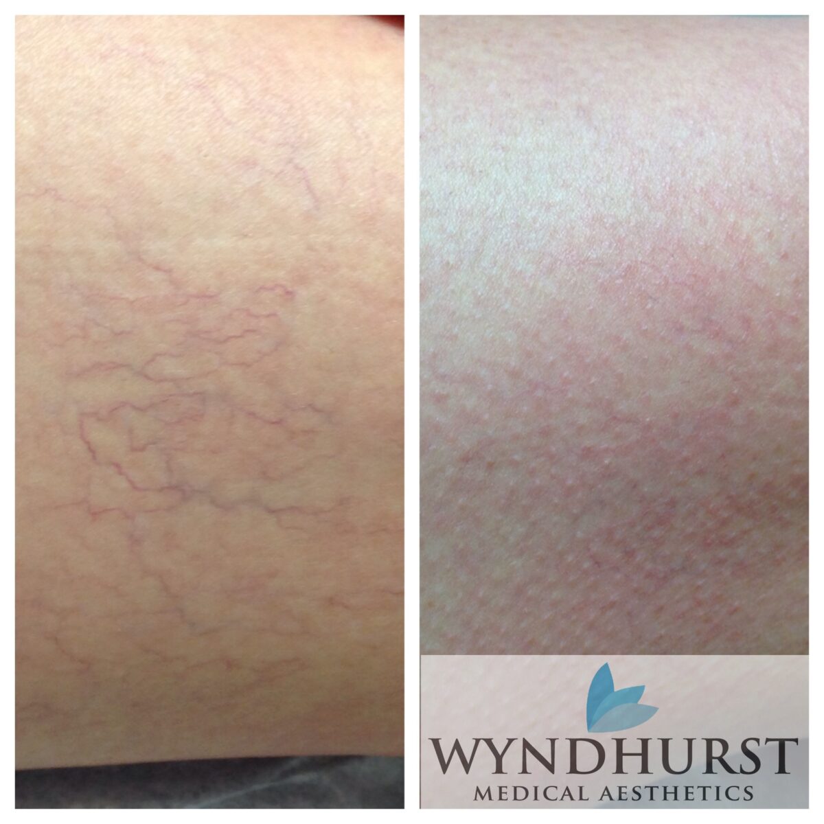 Laser Vein Treatments Before and After Photo by Wyndhurst Aesthetics in Lynchburg, VA