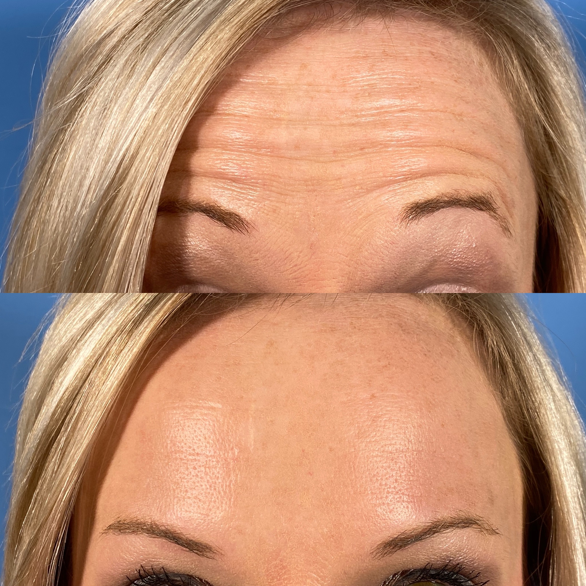 Botox + Fillers Before and After Photo by Wyndhurst Aesthetics in Lynchburg, VA