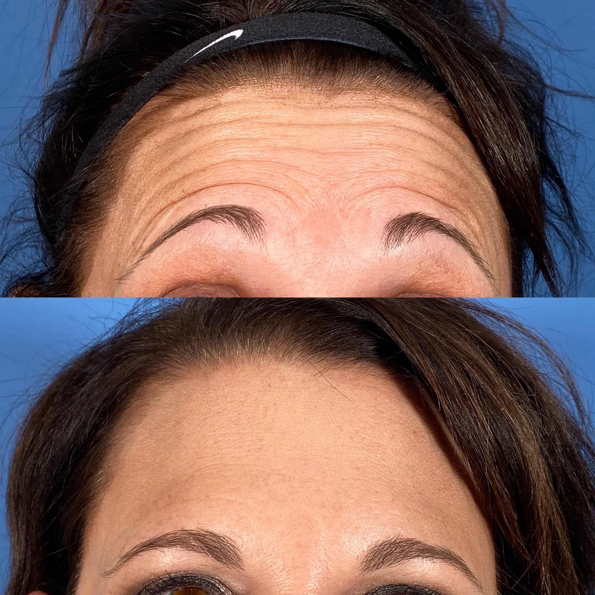 Botox + Fillers Before and After Photo by Wyndhurst Aesthetics in Lynchburg, VA