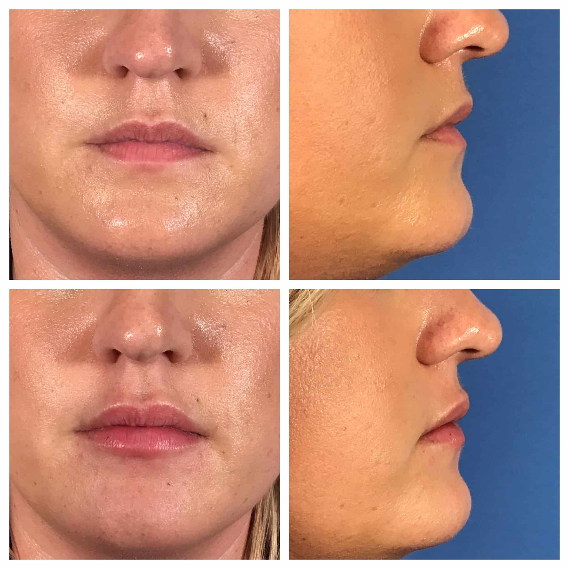 Botox + Fillers Before and After Photo by Wyndhurst Aesthetics in Lynchburg, VA