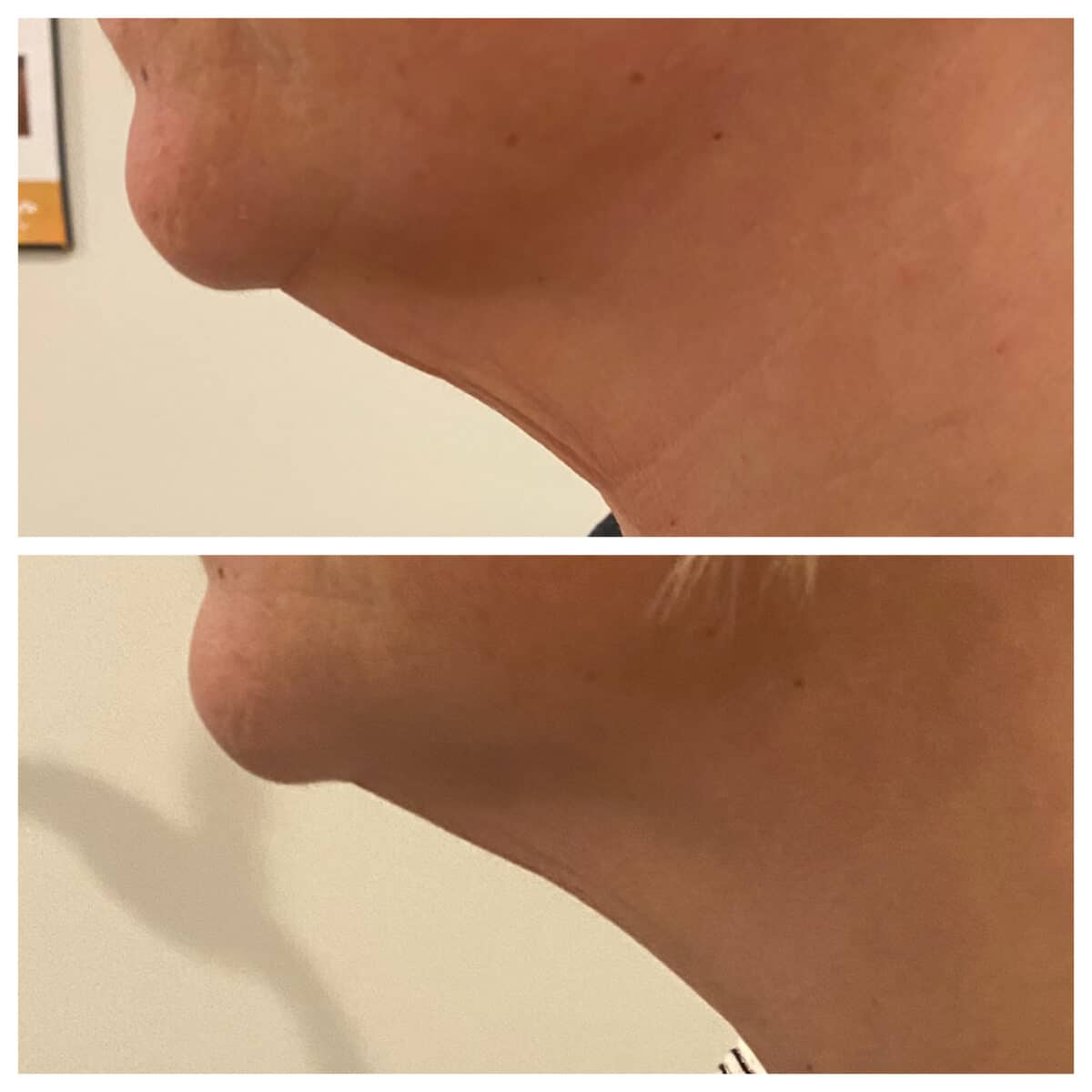 Kybella Before and After Photo by Wyndhurst Aesthetics in Lynchburg, VA
