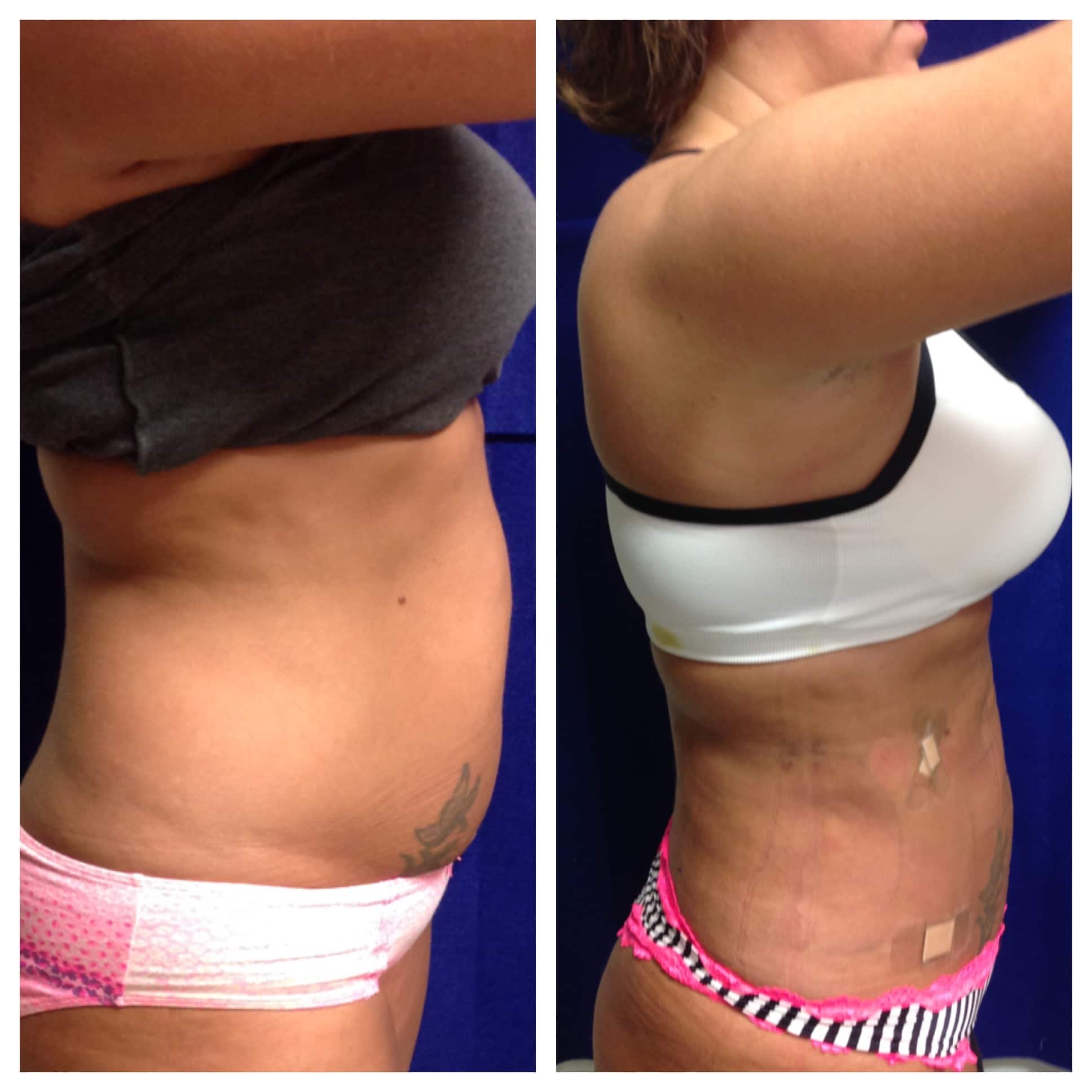 Smart Lipo Before and After Photo by Wyndhurst Aesthetics in Lynchburg, VA