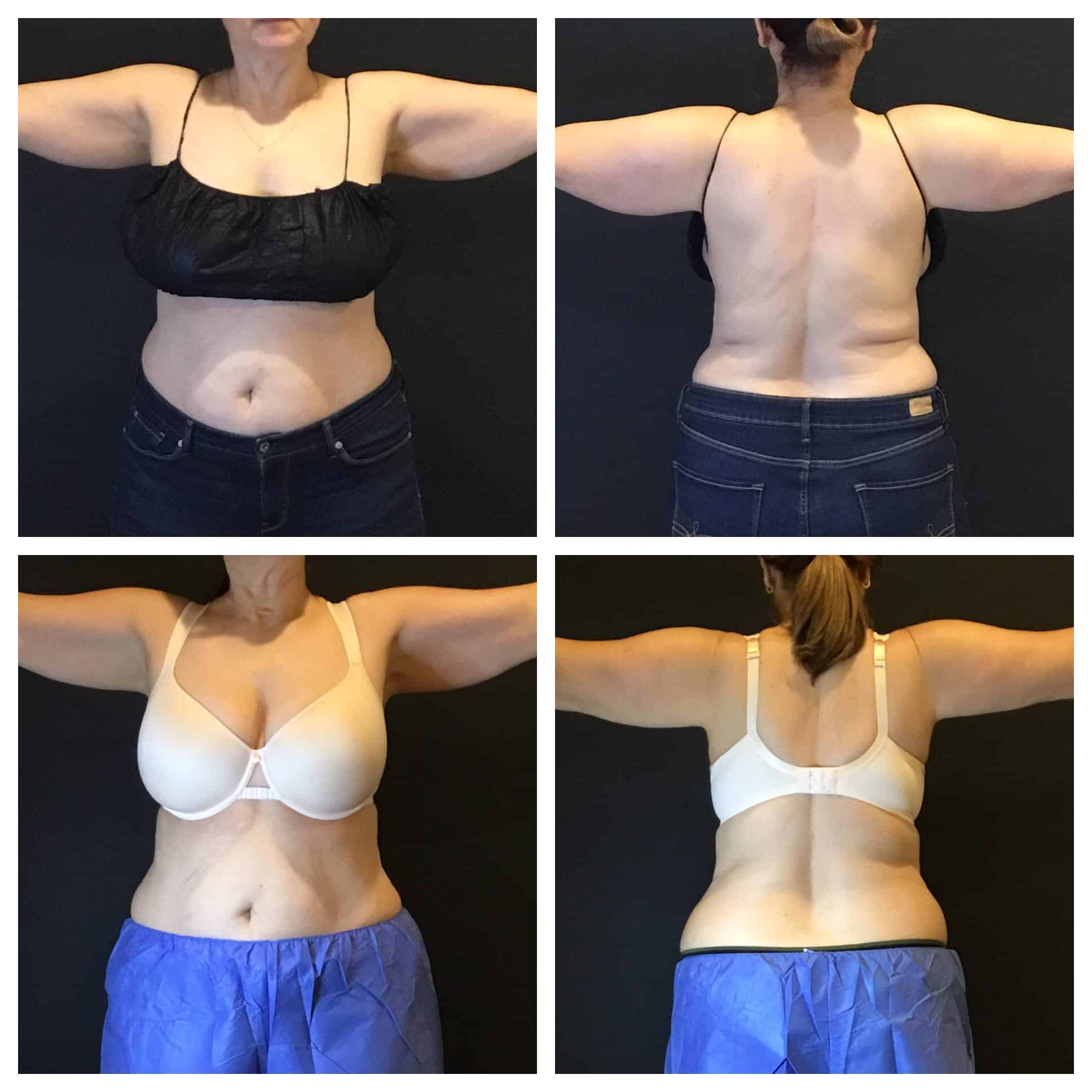 CoolSculpting Before and After Photo by Wyndhurst Aesthetics in Lynchburg, VA CoolSculpting Before and After Photo by Wyndhurst Aesthetics in Lynchburg, VA