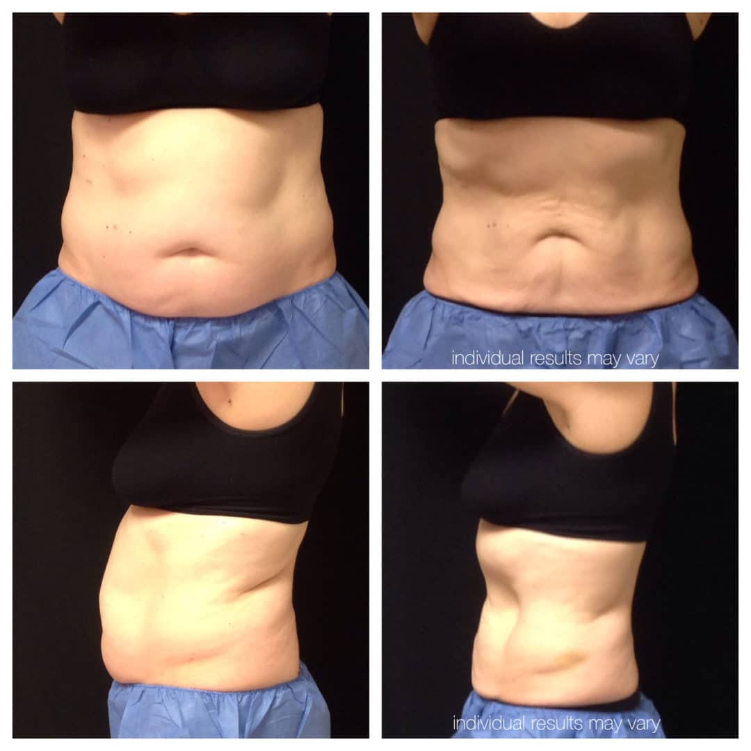 CoolSculpting Before and After Photo by Wyndhurst Aesthetics in Lynchburg, VA CoolSculpting Before and After Photo by Wyndhurst Aesthetics in Lynchburg, VA