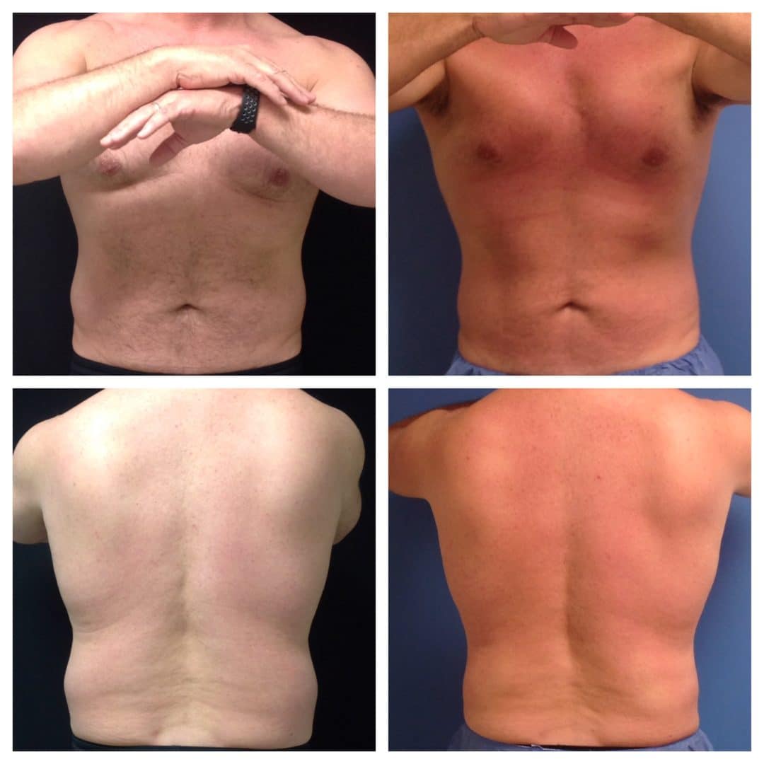 CoolSculpting Before and After Photo by Wyndhurst Aesthetics in Lynchburg, VA CoolSculpting Before and After Photo by Wyndhurst Aesthetics in Lynchburg, VA