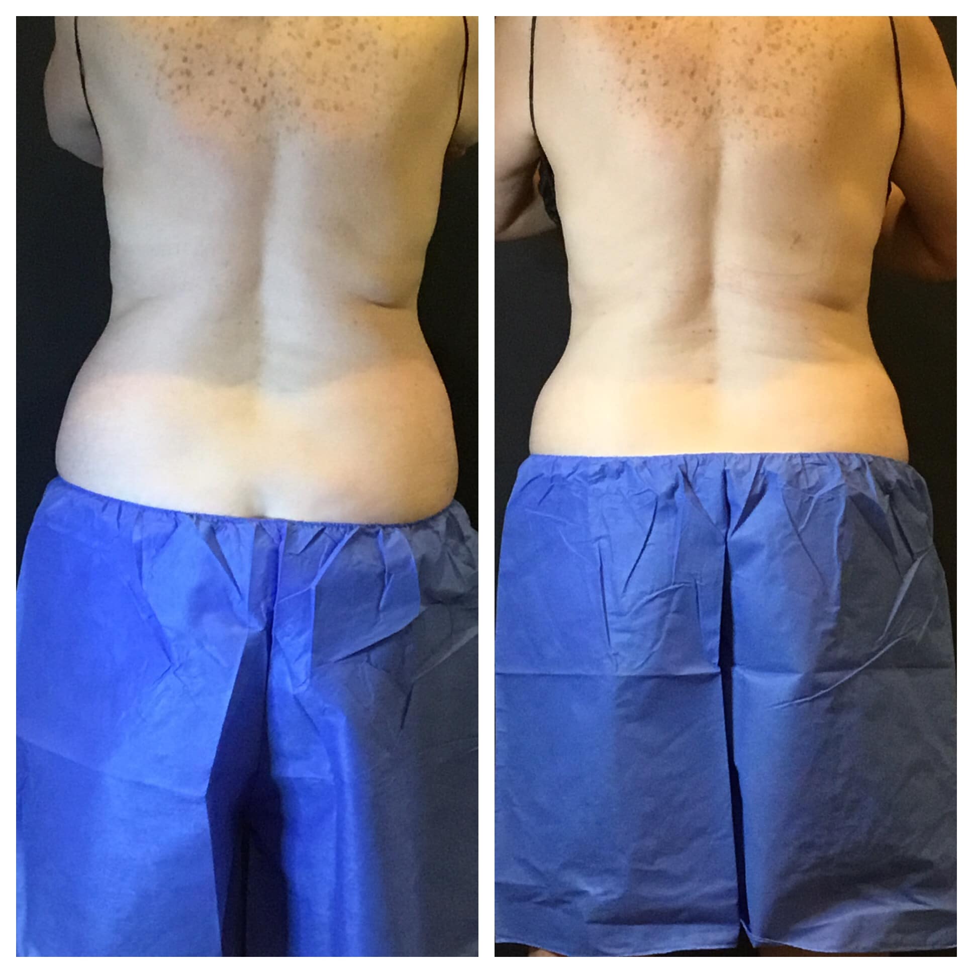 CoolSculpting Before and After Photo by Wyndhurst Aesthetics in Lynchburg, VA CoolSculpting Before and After Photo by Wyndhurst Aesthetics in Lynchburg, VA