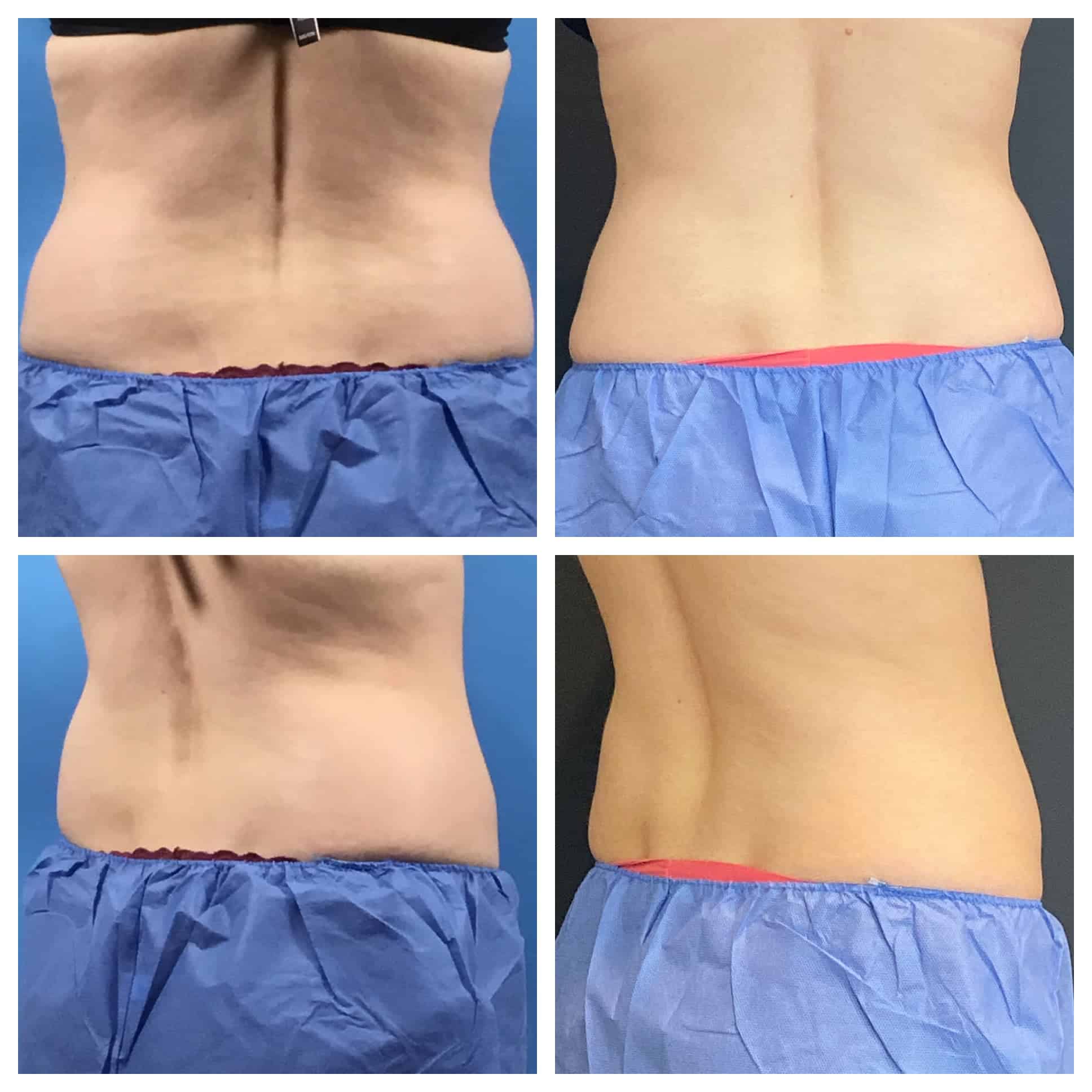 CoolSculpting Before and After Photo by Wyndhurst Aesthetics in Lynchburg, VA CoolSculpting Before and After Photo by Wyndhurst Aesthetics in Lynchburg, VA