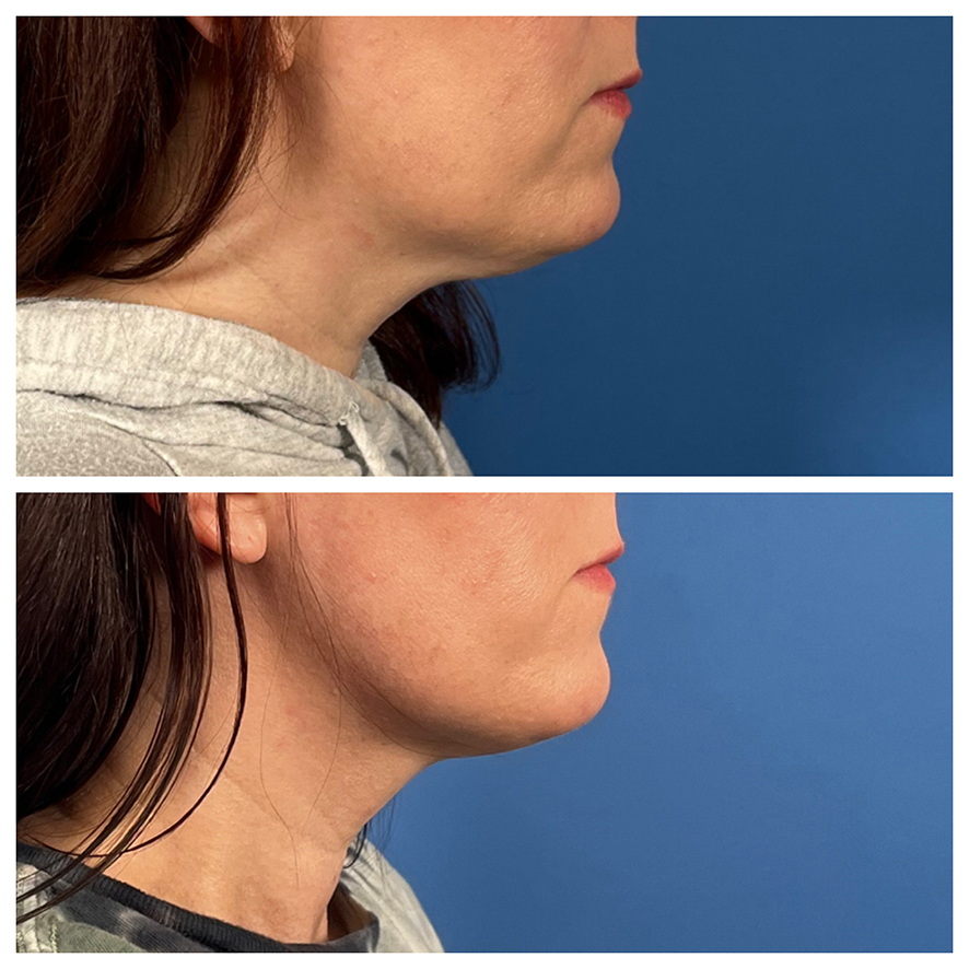 Kybella before and after photo