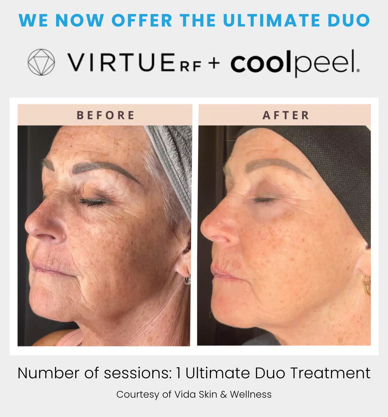 VirtueRF microneedling and CoolPeel CO2 laser Ultimate Duo treatment
